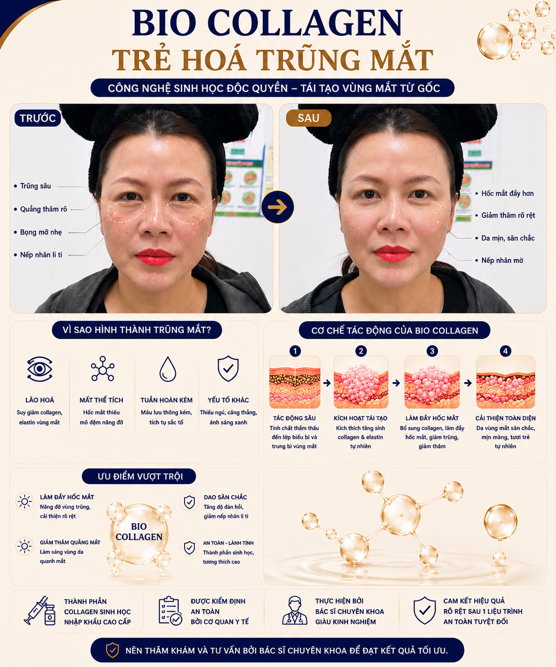 Trẻ hoá trũng mắt