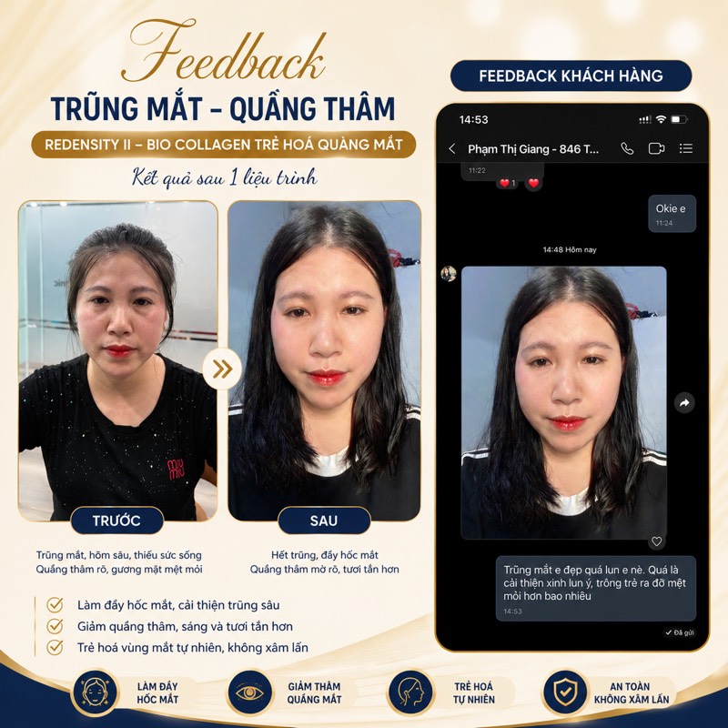 Feedback trũng mắt - Redensity II + BIO COLLAGEN