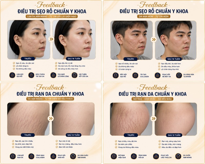 Feedback điều trị sẹo rỗ + rạn da