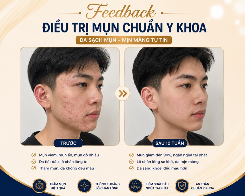 Feedback điều trị mụn nam