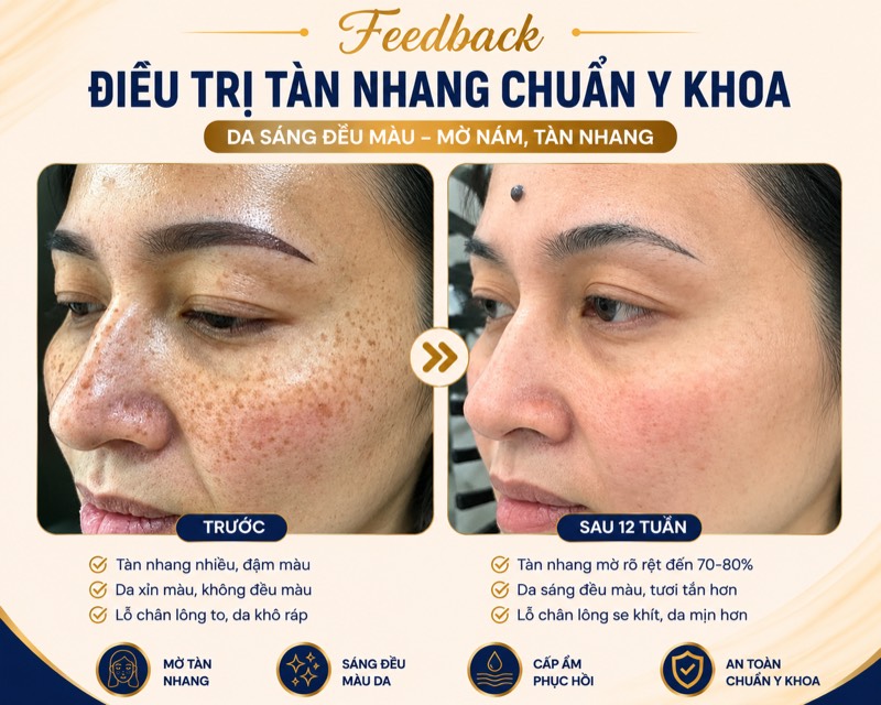 Feedback điều trị tàn nhang
